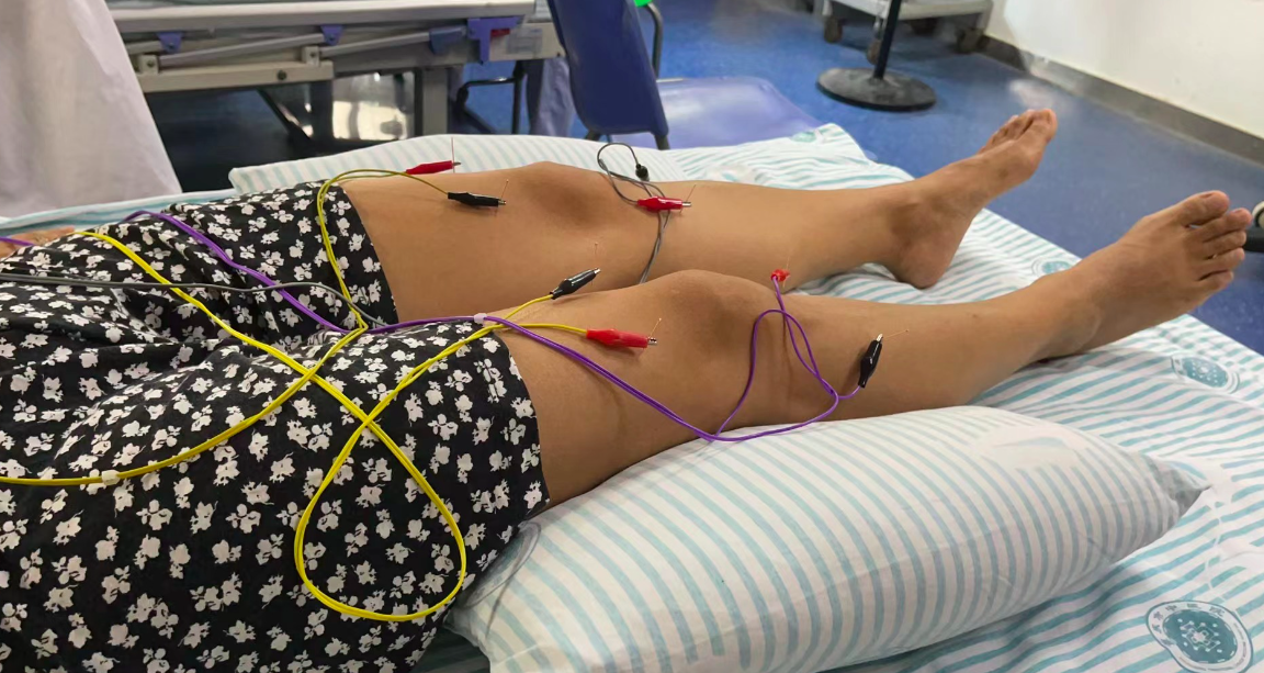 Traditional Chinese Medicine (TCM) includes electroacupuncture to help sports related and in this case, dance related injuries.